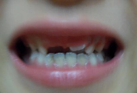 牙齿1.JPG