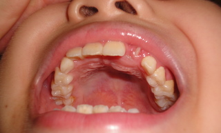 牙齿 2010-9-20 20-24-06.JPG